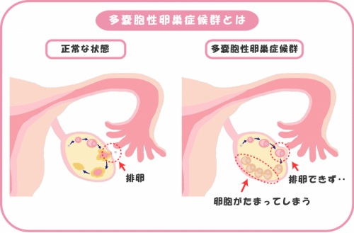 できること 多嚢胞性卵巣症候群 多嚢胞性卵巣症候群（PCOS）の原因と改善方法